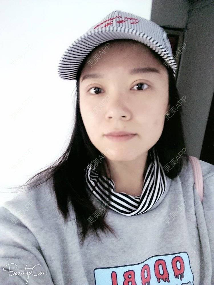 更美 - 更美用户5Pz3SpoBlS的果酸焕肤经验 | 果酸焕肤 | 济南