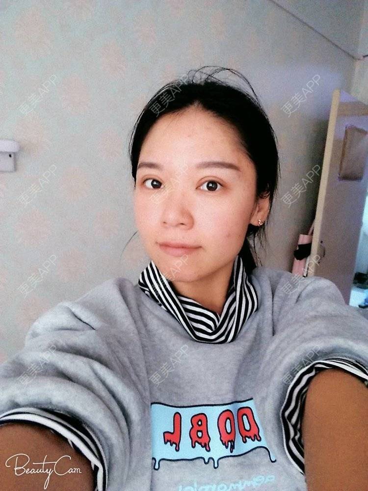 更美 - 更美用户5Pz3SpoBlS的果酸焕肤经验 | 果酸焕肤 | 济南