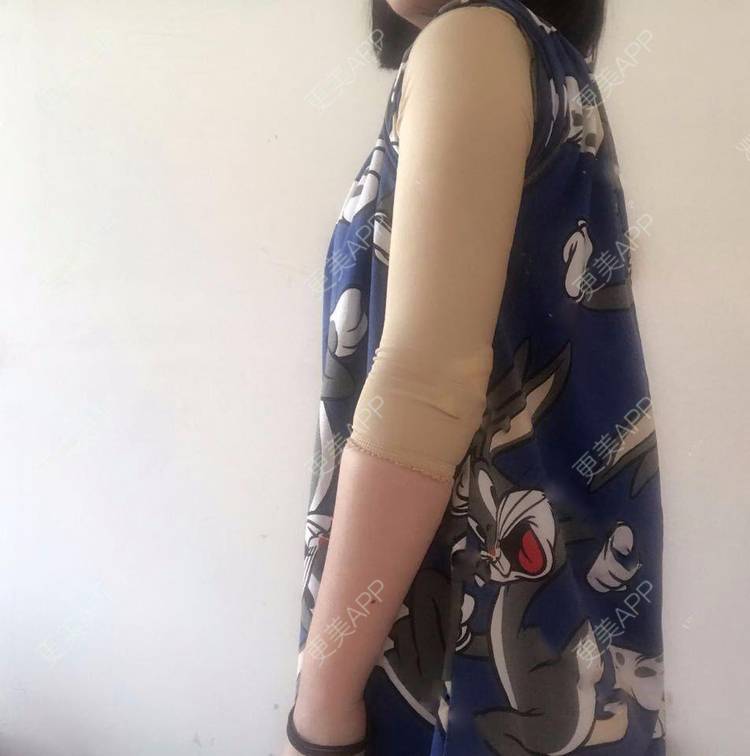 更美用户hfvqtflesi的吸脂去副乳日记