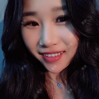 牙齿瓷贴面