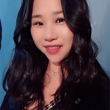牙齿瓷贴面
