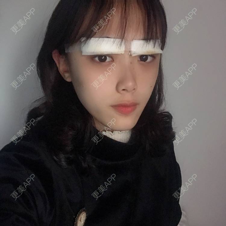 更美 - 王艳 医生的双眼皮经验 | 双眼皮 | 嘉兴