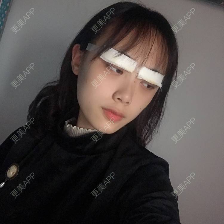 更美 - 王艳 医生的双眼皮经验 | 双眼皮 | 嘉兴