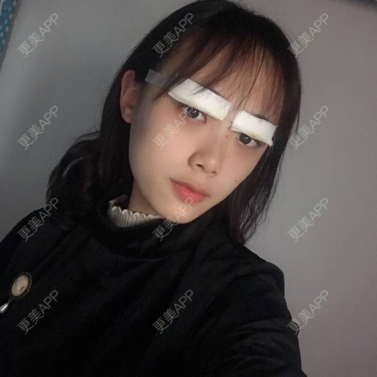 更美 - 王艳 医生的双眼皮经验 | 双眼皮 | 嘉兴