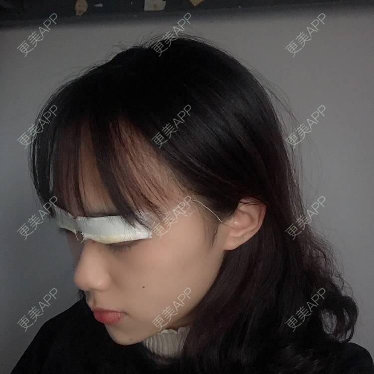 更美 - 王艳 医生的双眼皮经验 | 双眼皮 | 嘉兴