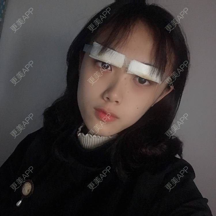更美 - 王艳 医生的双眼皮经验 | 双眼皮 | 嘉兴