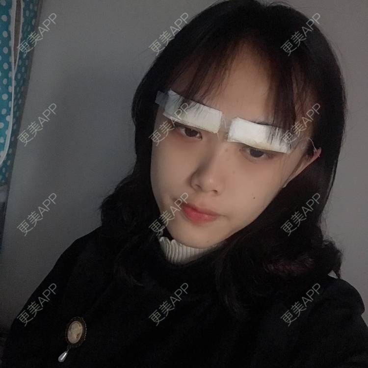 更美 - 王艳 医生的双眼皮经验 | 双眼皮 | 嘉兴