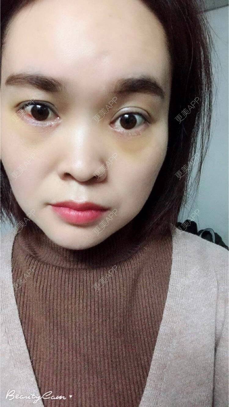 更美用户ch60ejaxlo的外切去眼袋日记