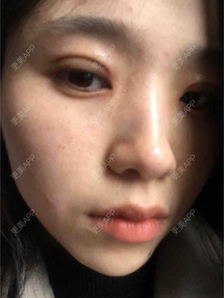 更美 - 更美用户NrtSphbqU1的全切双眼皮经验 | 全切双眼皮 | 宁波