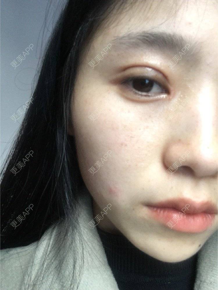更美 - 更美用户NrtSphbqU1的全切双眼皮经验 | 全切双眼皮 | 宁波