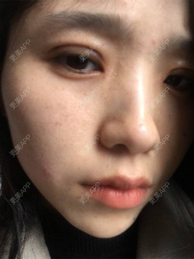 更美 - 更美用户NrtSphbqU1的全切双眼皮经验 | 全切双眼皮 | 宁波