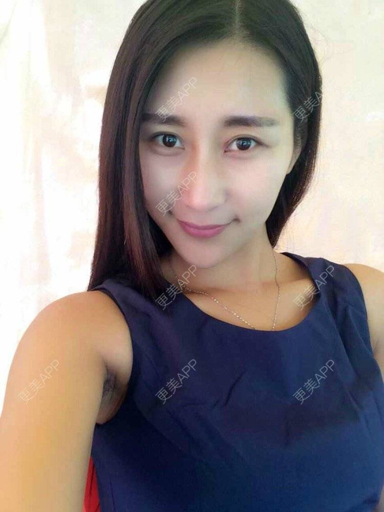 袁娅楠的鼻综合日记