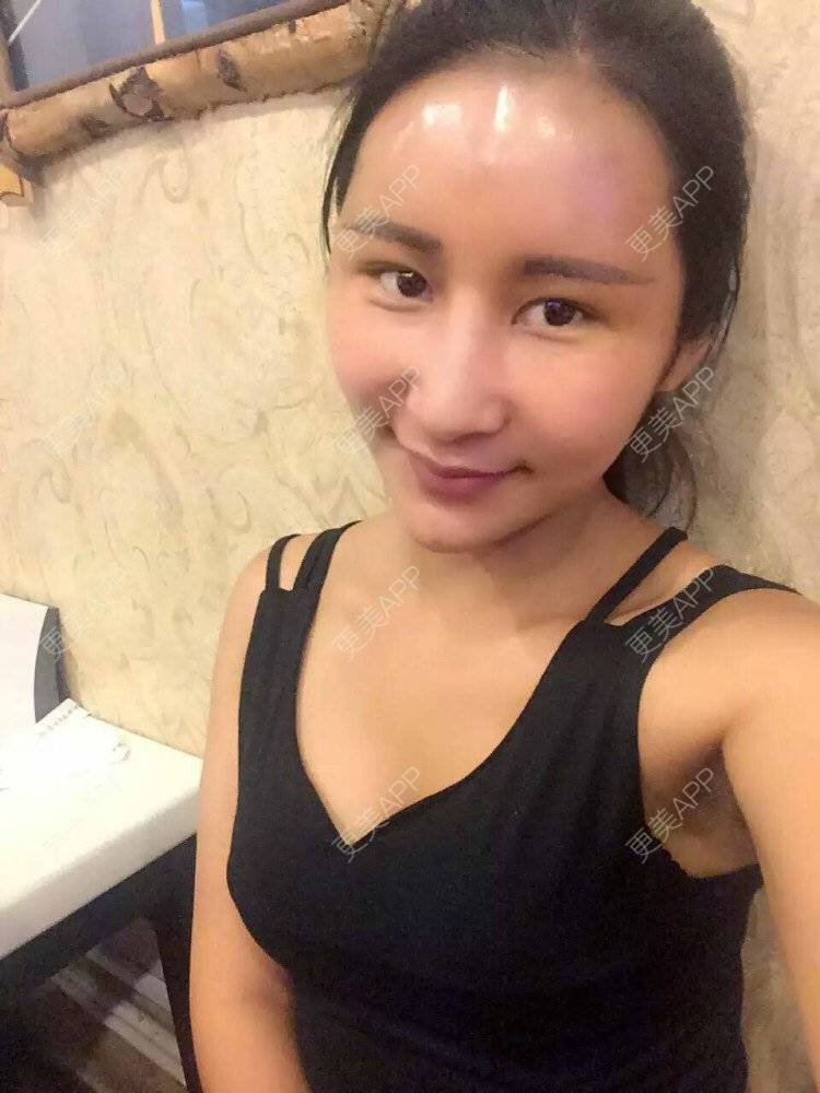 袁娅楠的鼻综合日记