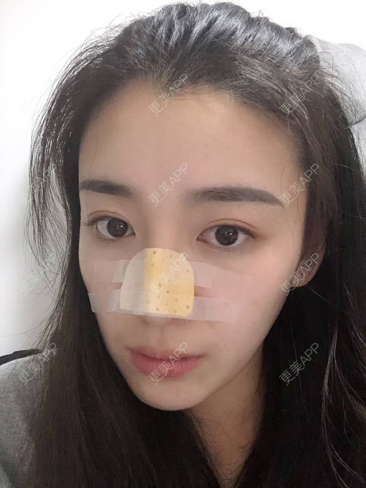 更美 - 范萌知 医生的隆鼻经验 | 隆鼻 | 嘉兴