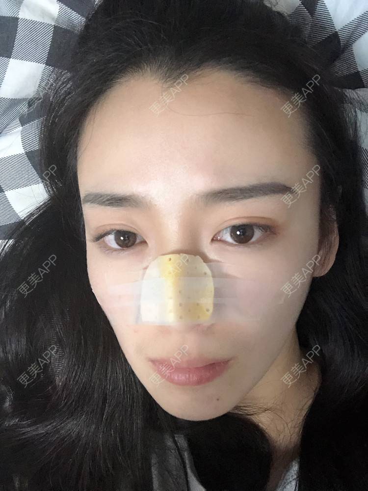 更美 - 范萌知 医生的隆鼻经验 | 隆鼻 | 嘉兴