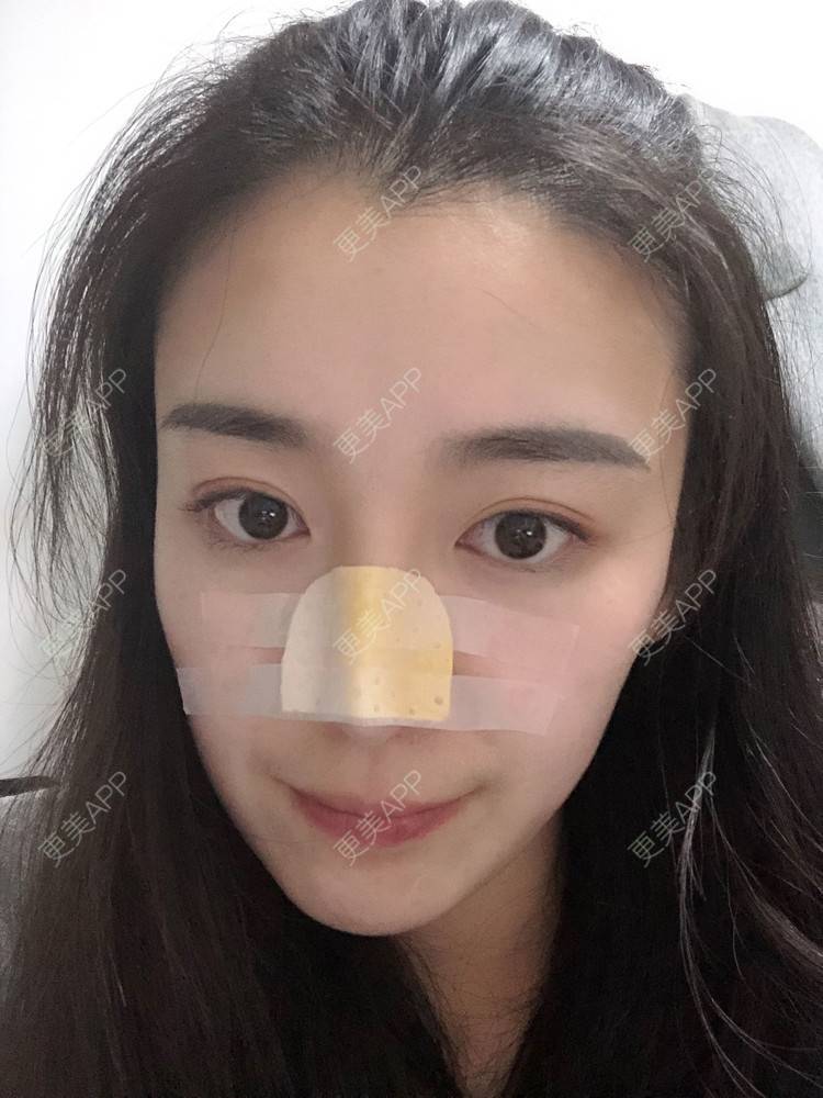 更美 - 范萌知 医生的隆鼻经验 | 隆鼻 | 嘉兴