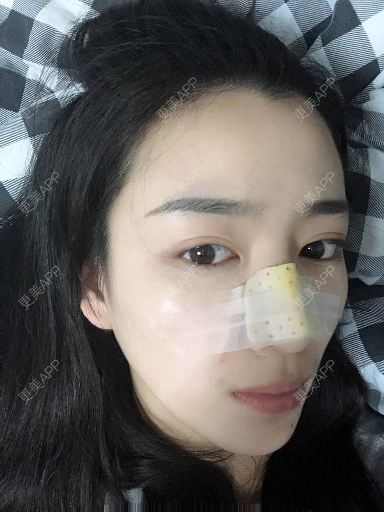 更美 - 范萌知 医生的隆鼻经验 | 隆鼻 | 嘉兴