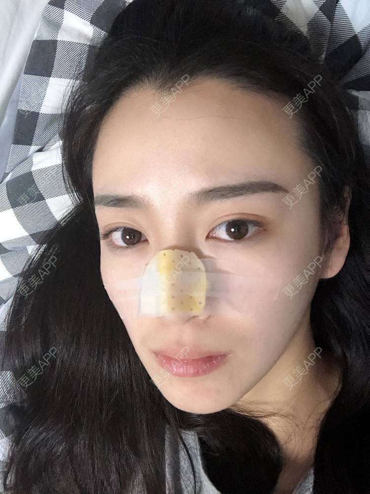 更美 - 范萌知 医生的隆鼻经验 | 隆鼻 | 嘉兴