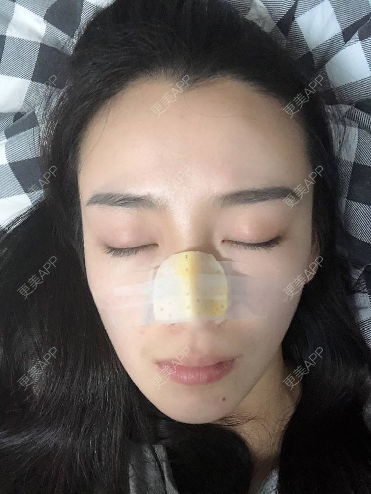 更美 - 范萌知 医生的隆鼻经验 | 隆鼻 | 嘉兴