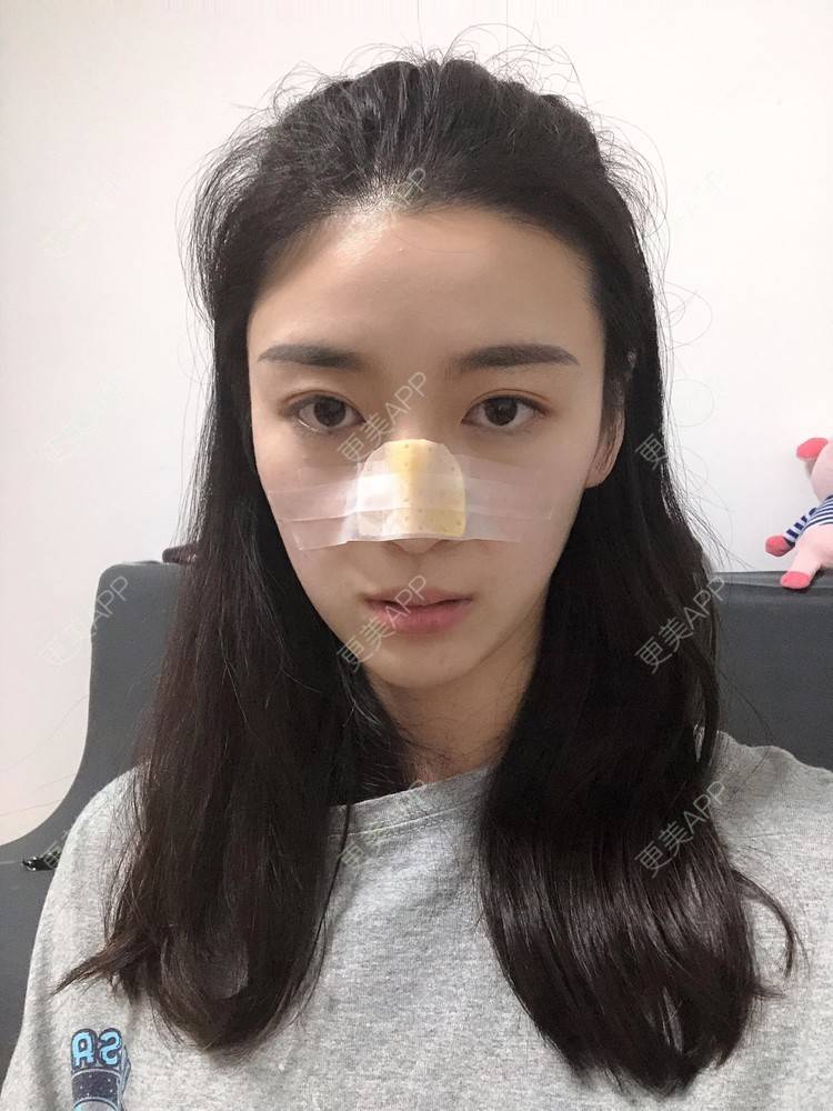 更美 - 范萌知 医生的隆鼻经验 | 隆鼻 | 嘉兴