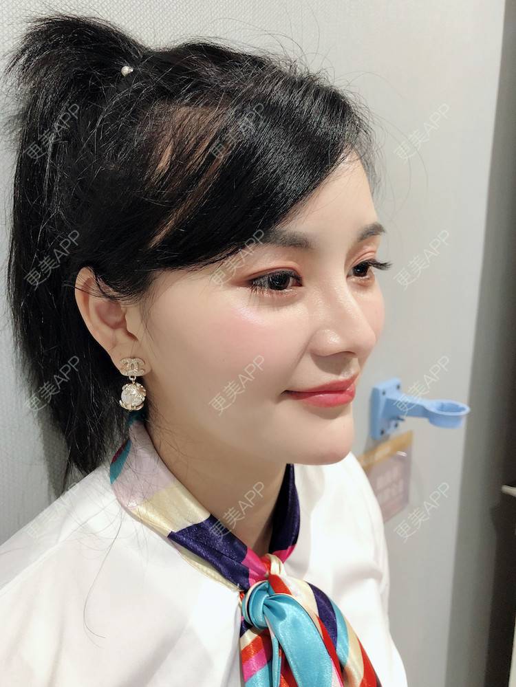 更美 - 浅夏微凉L的双下巴吸脂经验 | 深圳 | 双下巴吸脂