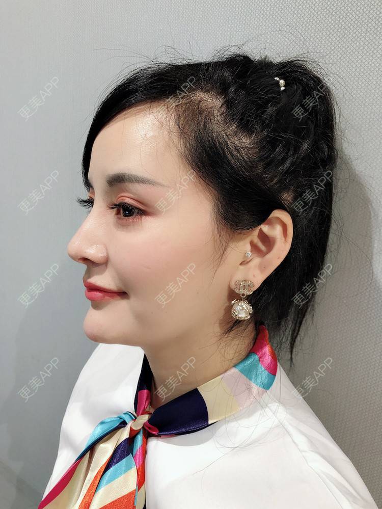 更美 - 浅夏微凉L的双下巴吸脂经验 | 深圳 | 双下巴吸脂