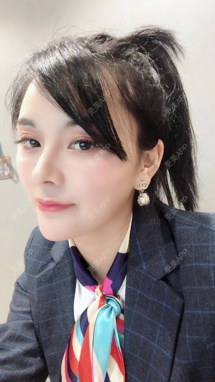 更美 - 浅夏微凉L的双下巴吸脂经验 | 深圳 | 双下巴吸脂