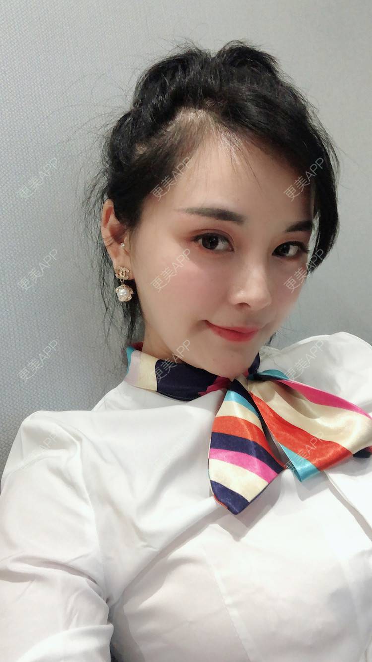 更美 - 浅夏微凉L的双下巴吸脂经验 | 深圳 | 双下巴吸脂