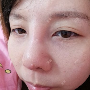 鼻部多项