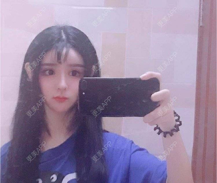 更美 - 老街上的猫的吸脂瘦脸经验 | 南昌 | 视频日记 | 吸脂瘦脸