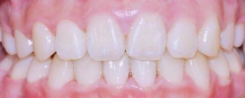 更美 - 更美用户vPnp23rTit的超声波洗牙经验 | 成都 | 超声波洗牙