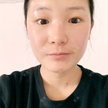 手臂吸脂