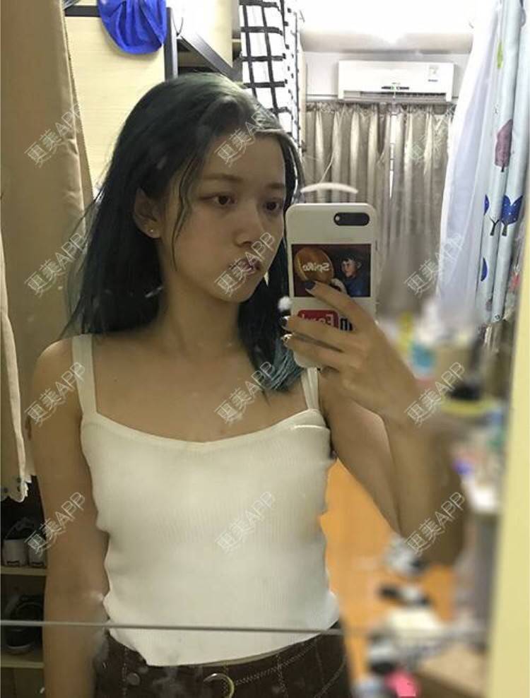 更美 - 袭人旅的假体隆胸经验 | 广州 | 假体隆胸 | 根管治疗 | 深圳