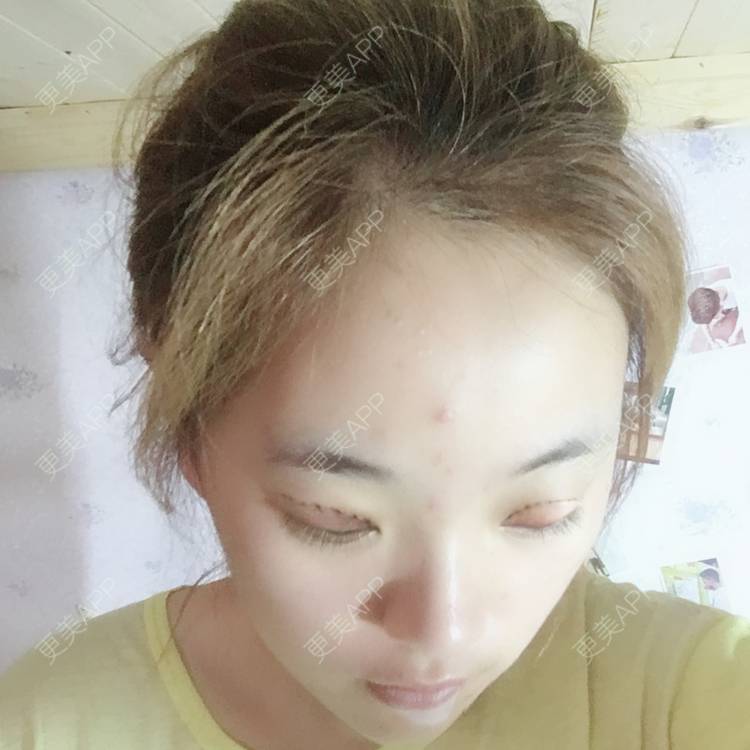 更美 - 孔庆颂 医生的眼部综合经验 | 眼部综合 | 全切双眼皮 | 无锡