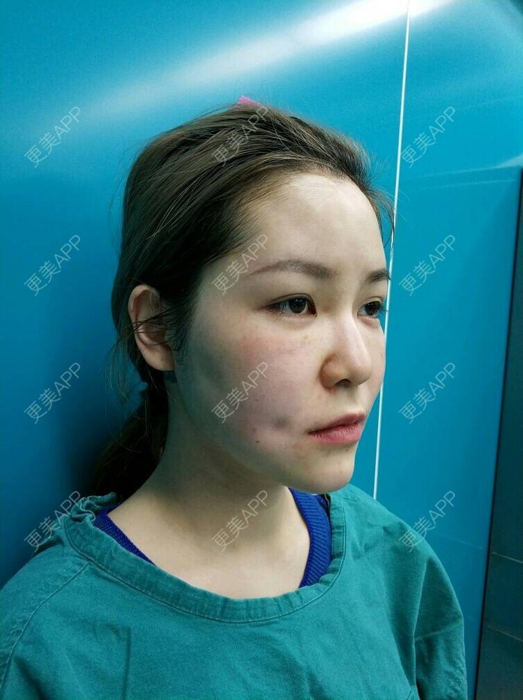 酒窝成形术手术_好少逆天酒窝成形术手术_更美整形