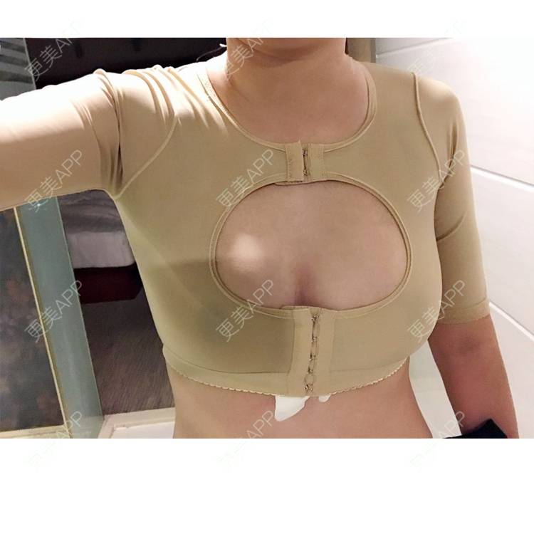 更美 - 更美用户w0EgqkDyDz的肩部吸脂经验 | 背部吸脂 | 深圳 | 吸脂 | 肩部吸脂