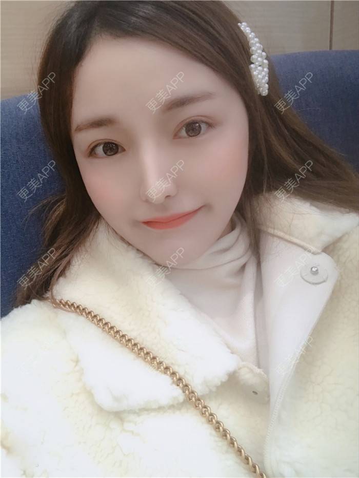 更美 - 小小恩菲的耳软骨隆鼻经验 | 视频日记 | 耳软骨隆鼻 | 重庆