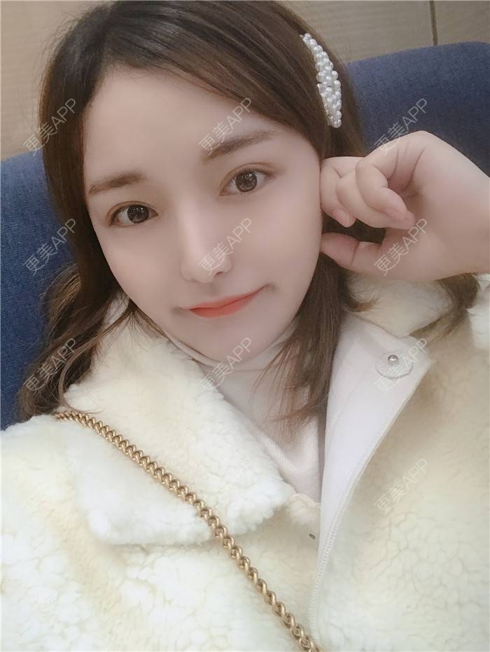 更美 - 小小恩菲的耳软骨隆鼻经验 | 视频日记 | 耳软骨隆鼻 | 重庆