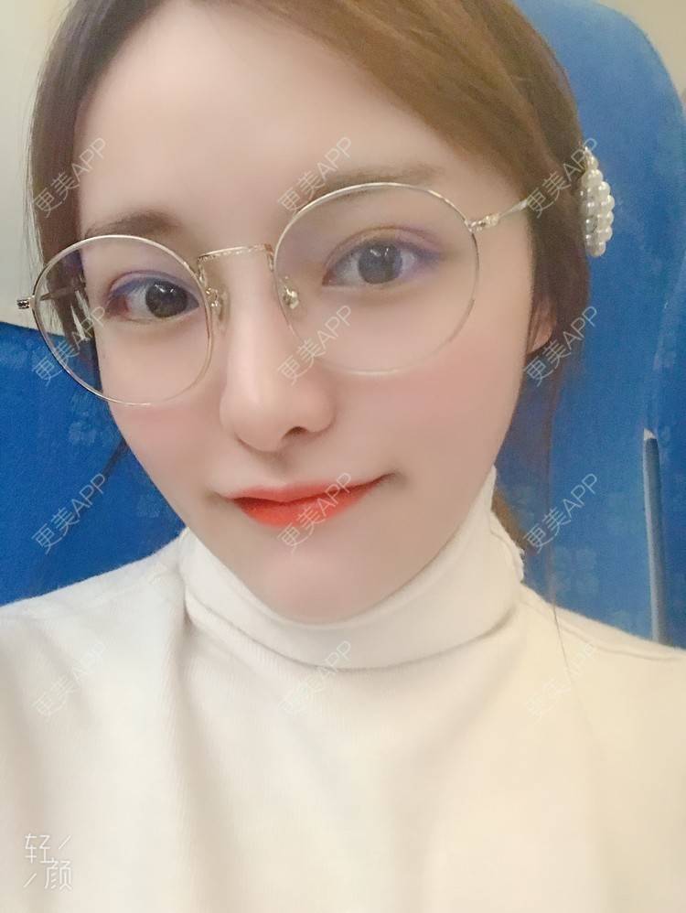 更美 - 小小恩菲的耳软骨隆鼻经验 | 视频日记 | 耳软骨隆鼻 | 重庆