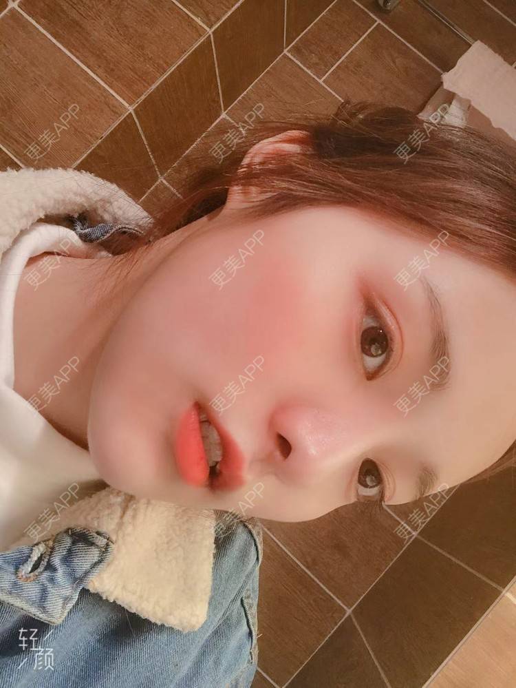 更美 - 小小恩菲的耳软骨隆鼻经验 | 视频日记 | 耳软骨隆鼻 | 重庆