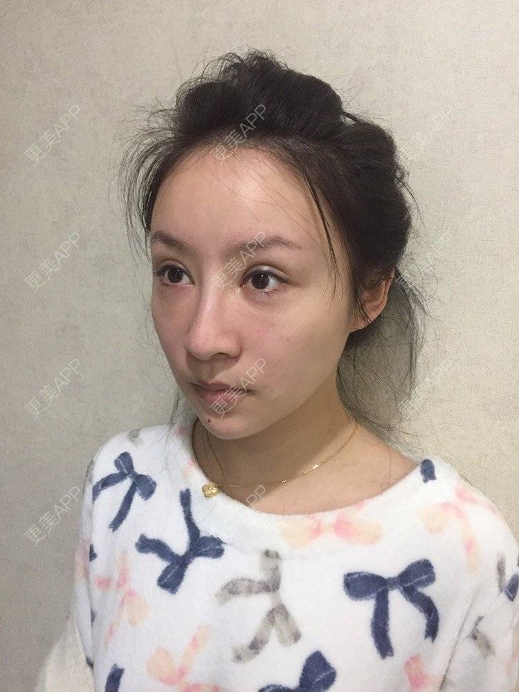 更美 - 卡门小妖精，的玻尿酸卧蚕经验 | 自体脂肪丰卧蚕 | 真皮丰卧蚕 | 玻尿酸卧蚕 | 眼部多项 | 双眼皮修复 | 重庆