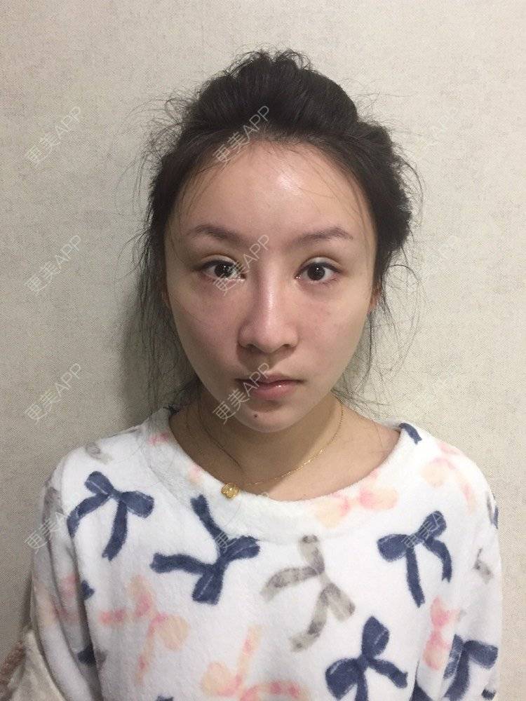 更美 - 卡门小妖精，的玻尿酸卧蚕经验 | 自体脂肪丰卧蚕 | 真皮丰卧蚕 | 玻尿酸卧蚕 | 眼部多项 | 双眼皮修复 | 重庆