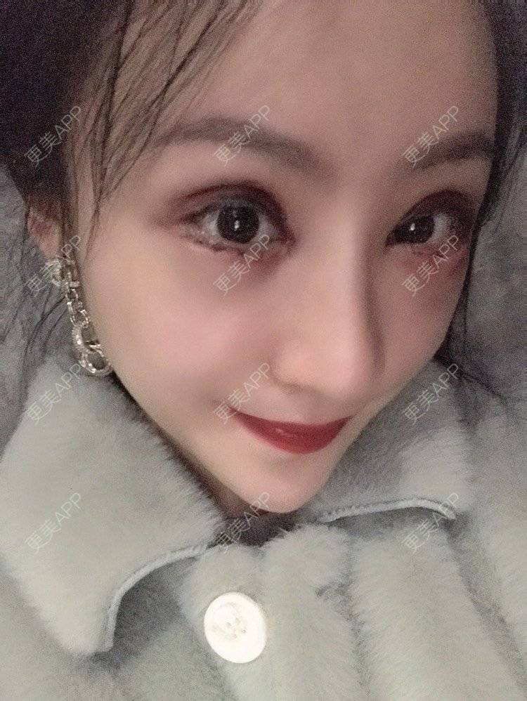 更美 - 卡门小妖精，的玻尿酸卧蚕经验 | 自体脂肪丰卧蚕 | 真皮丰卧蚕 | 玻尿酸卧蚕 | 眼部多项 | 双眼皮修复 | 重庆