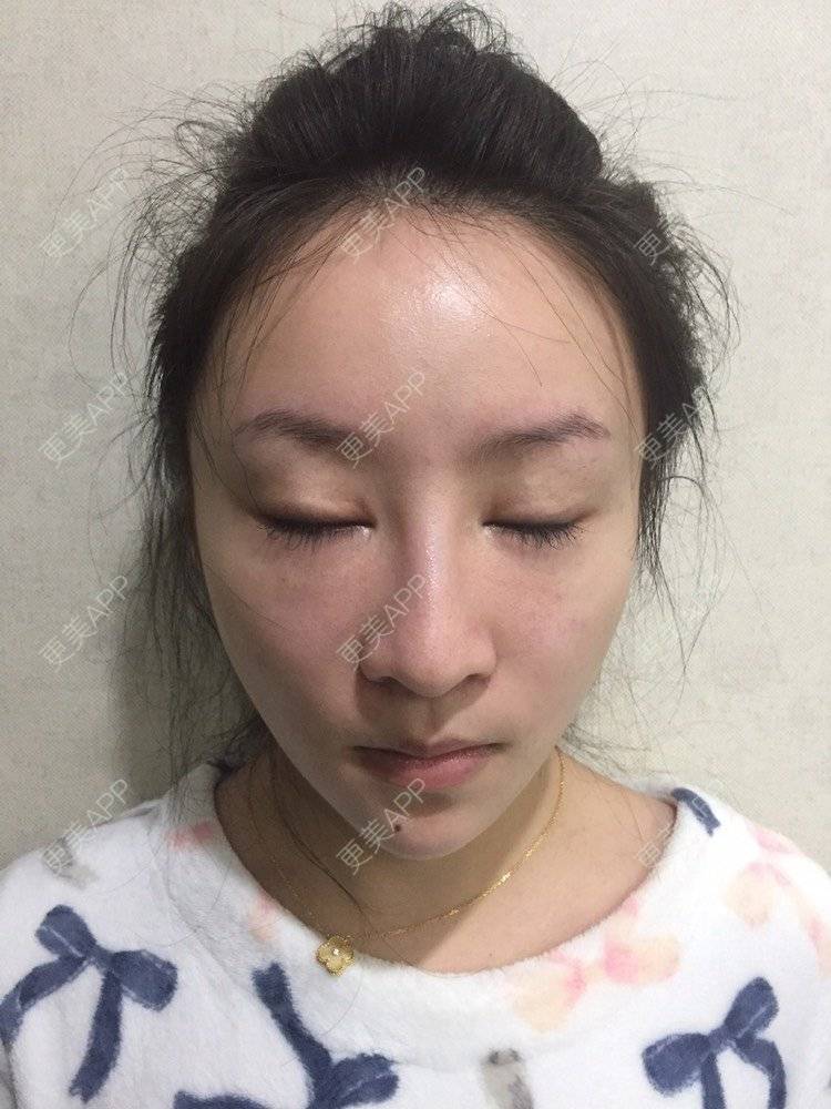 更美 - 卡门小妖精，的玻尿酸卧蚕经验 | 自体脂肪丰卧蚕 | 真皮丰卧蚕 | 玻尿酸卧蚕 | 眼部多项 | 双眼皮修复 | 重庆