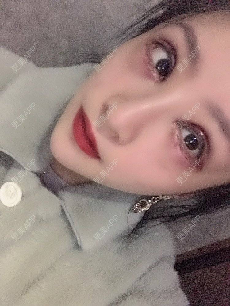 更美 - 卡门小妖精，的玻尿酸卧蚕经验 | 自体脂肪丰卧蚕 | 真皮丰卧蚕 | 玻尿酸卧蚕 | 眼部多项 | 双眼皮修复 | 重庆