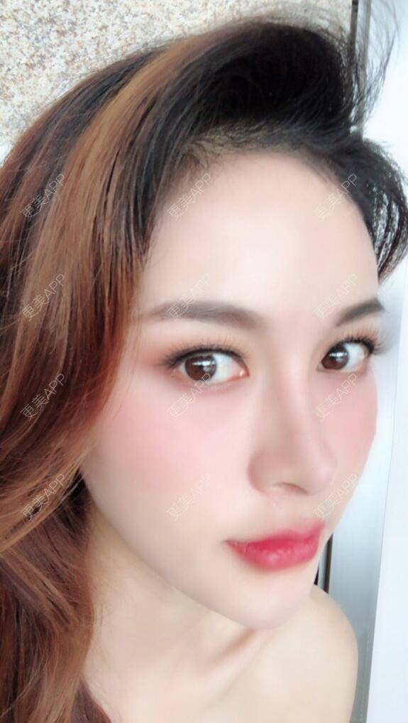 更美用户pybnupacob的隆鼻日记