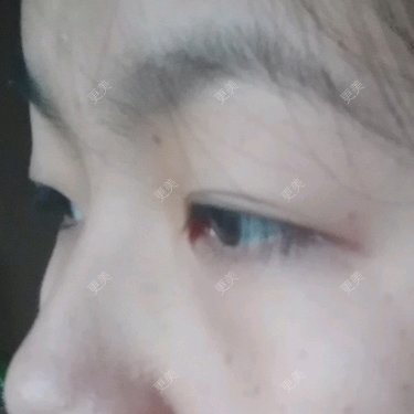 内切去眼袋