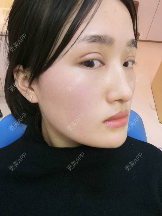 更美 - 淑芳宅_斋的玻尿酸鼻部经验 | 玻尿酸鼻部 | 鼻部多项 | 牙齿美白 | 玻尿酸 | 长沙
