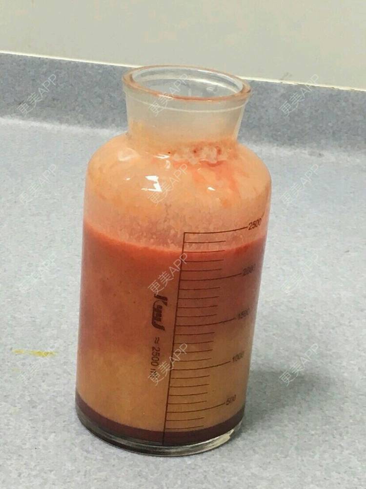 更美 - 更美用户8QYium9ZlI的吸脂经验 | 鼻部修复 | 厦门 | 西安 | 水氧活肤 | 北京 | 埋线提升 | 水光项目 | 注射塑形腿部 | 双眼皮 | 郑州 | 福州 | 隐形牙齿矫正 | 上海 | 南昌 | 吸脂 | 种植牙