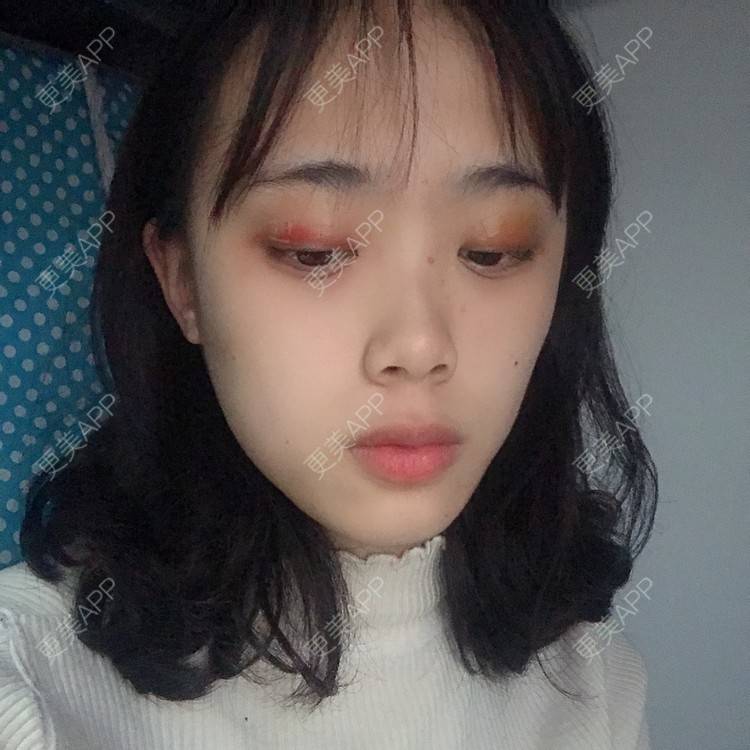 更美 - 王艳 医生的双眼皮经验 | 双眼皮 | 嘉兴